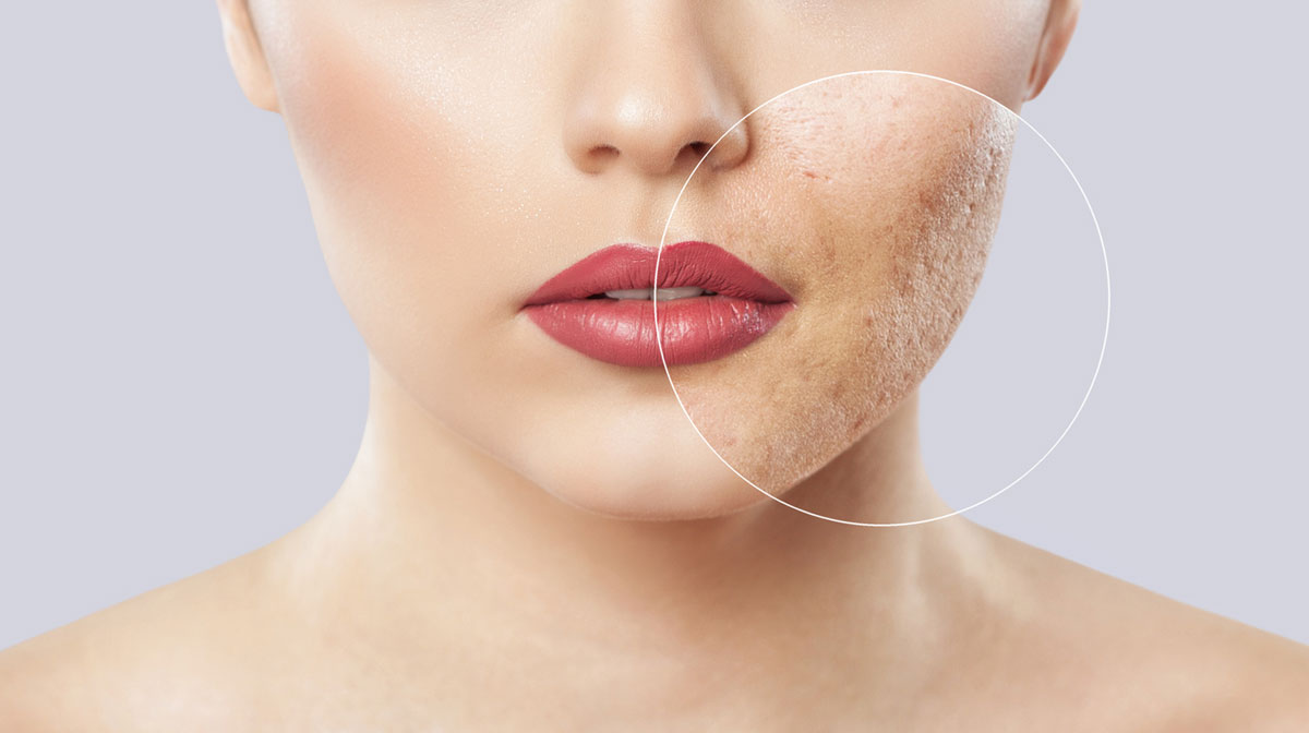 Acne Scars Treatment In Mumbai at mumbai cosmetic centre