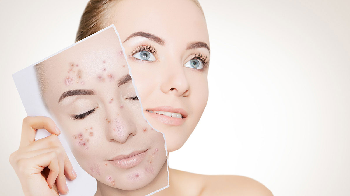 Acne Removal Treatment In Mumbai at Mumbai cosmetic Centre