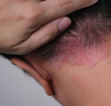 Causes of Dandruff Fungal Infection