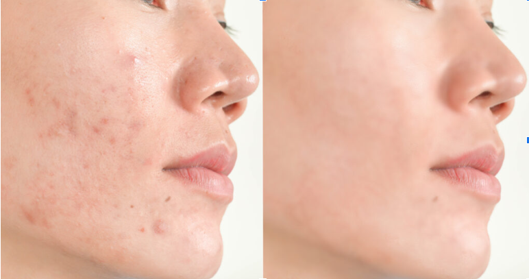 Hydrafacial treatment before-after results in mumbai at mumbai cosmetic centre