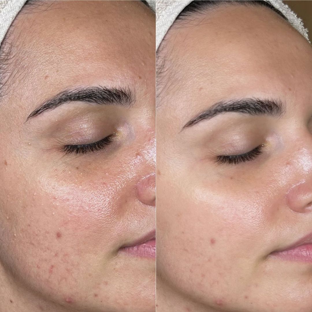 Hydrafacial treatment before after results in mumbai at mumbai cosmetic centre