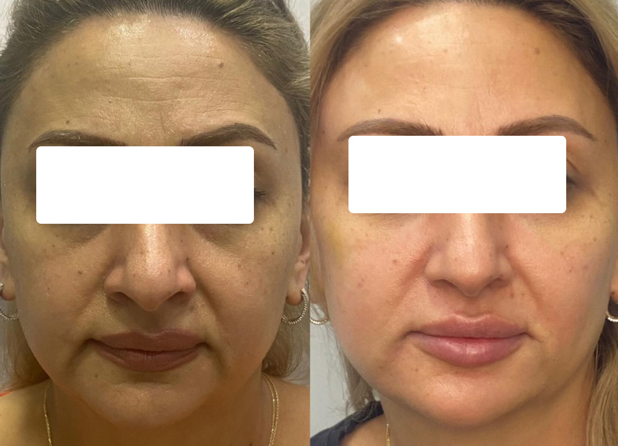 Botox Before and After - Frown Lines results at mumbai cosmetic centre