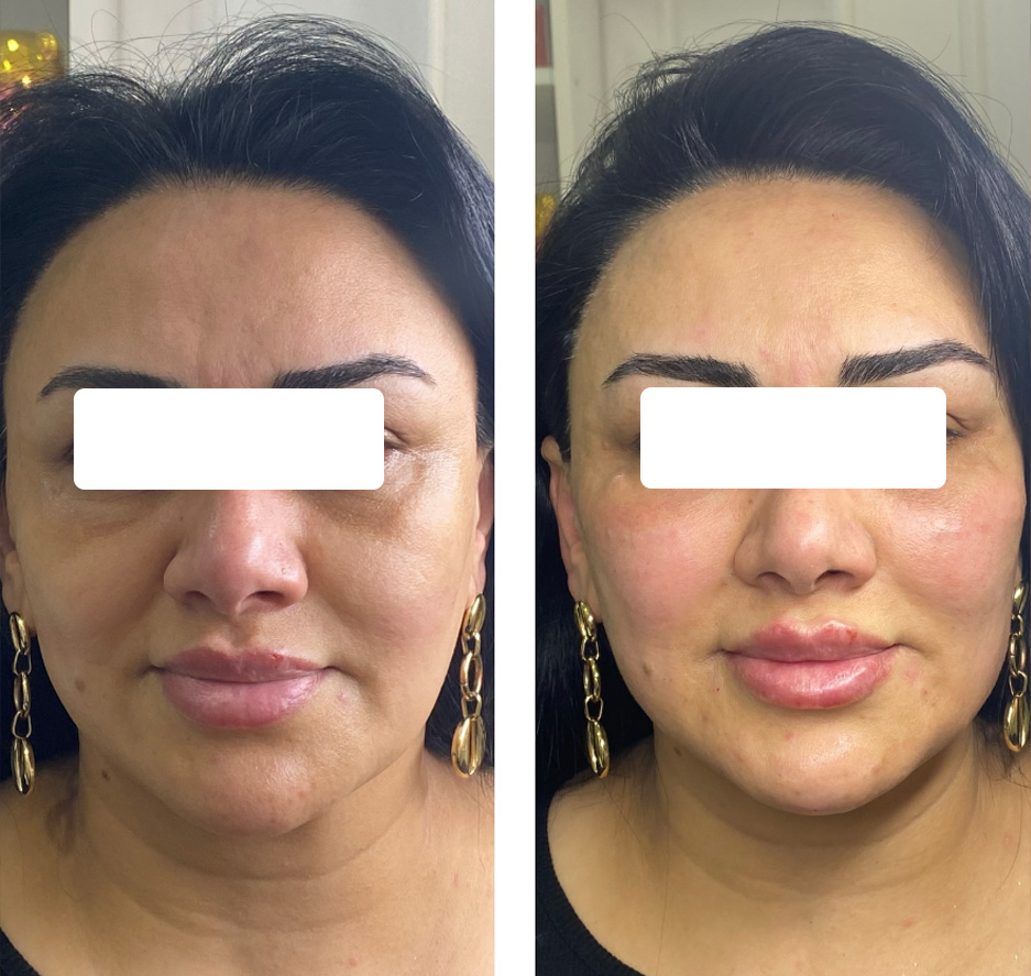 Botox Before and After - Frown Lines results at mumbai cosmetic centre