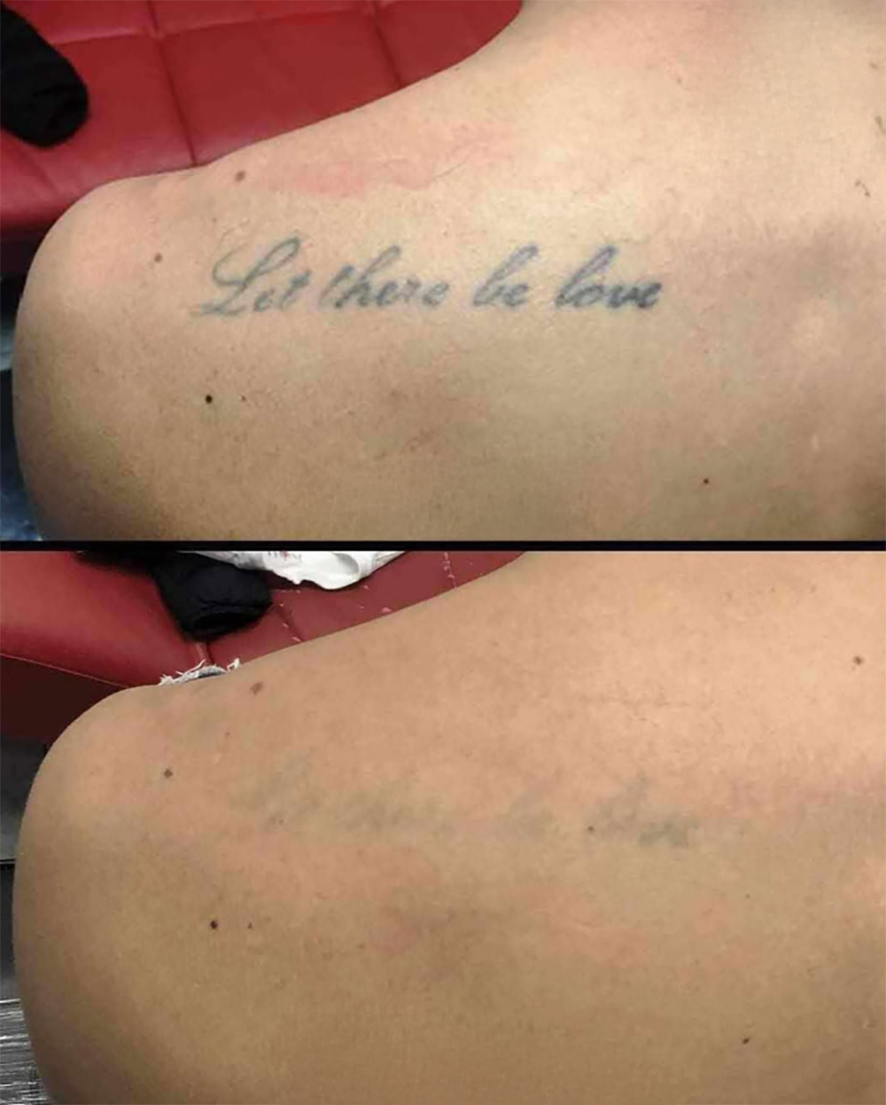 Laser Tattoo Removal in mumbai at mumbai cosmetic centre, Before-After Result after 2 weeks