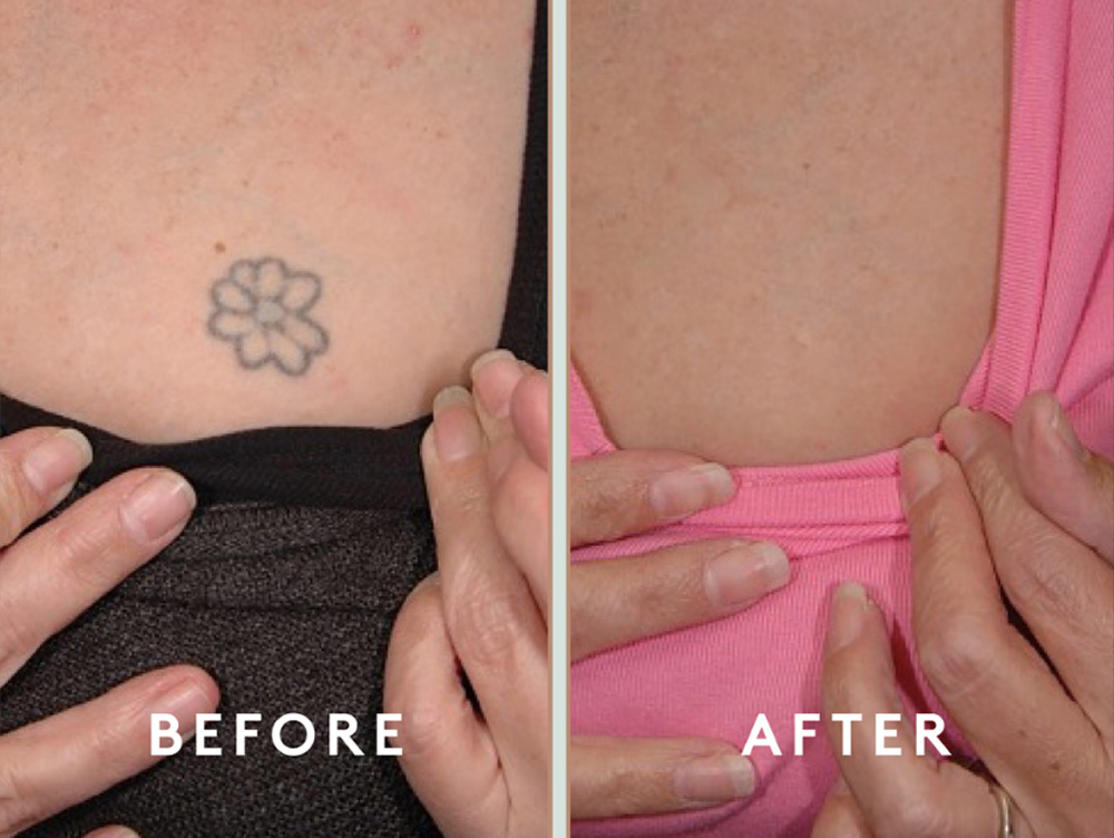 Laser Tattoo Removal in mumbai at mumbai cosmetic centre, Before After Result 5