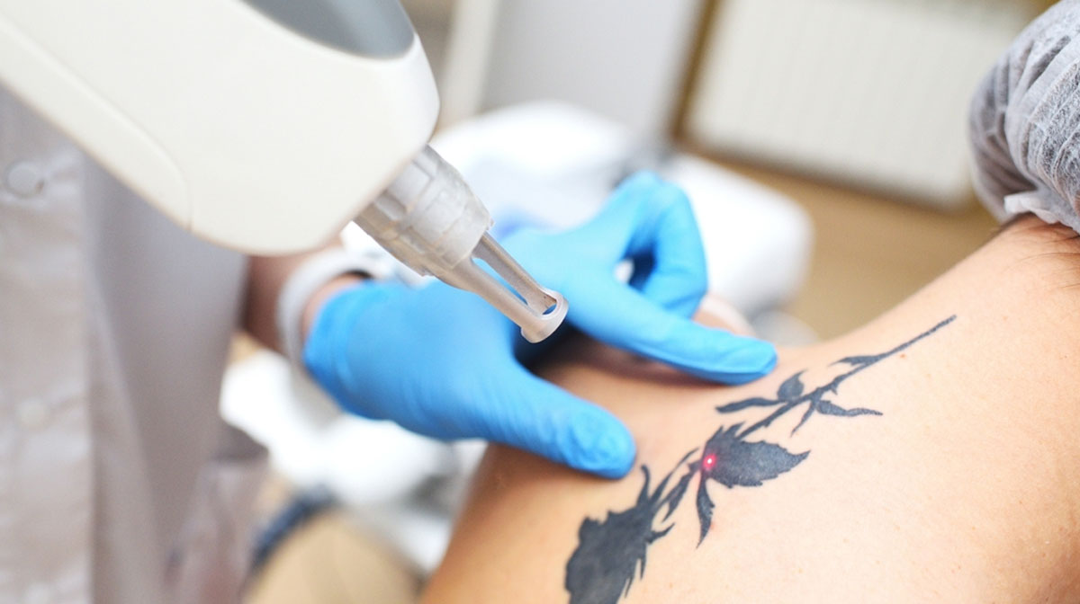Tattoo removal procedure in Mumbai at Mumbai Cosmetic Centre