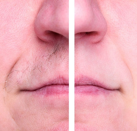Effect of Upper Lip Laser Hair Removal Treatment in Mumbai at Mumbai Cosmetic Centre